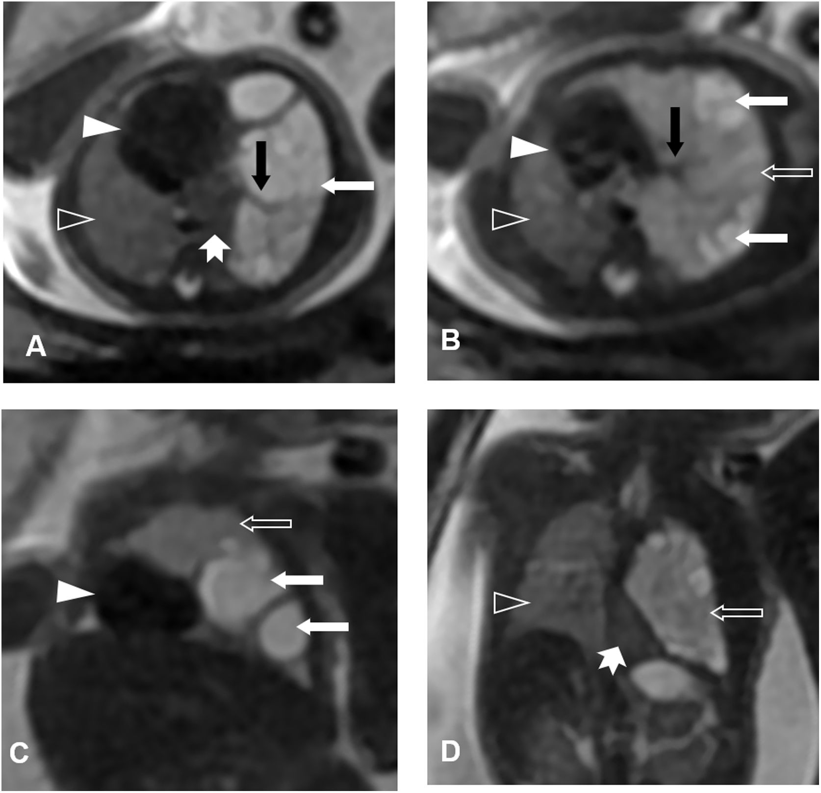 Foetal MRI for cardiovascular and thoracic diseases | Radiología ...