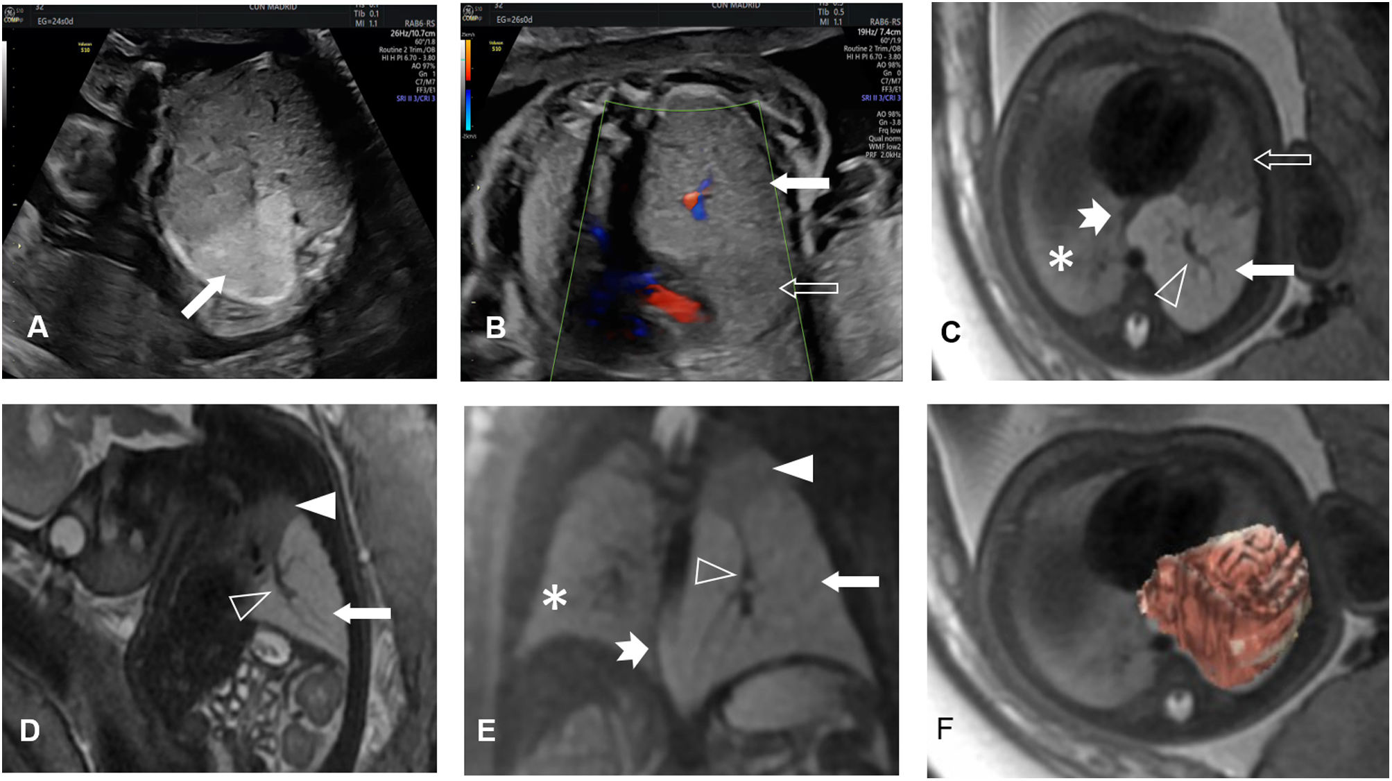 Foetal MRI for cardiovascular and thoracic diseases | Radiología ...