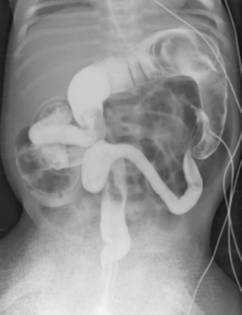 Imaging of neonatal bowel obstruction | Radiología (English Edition)