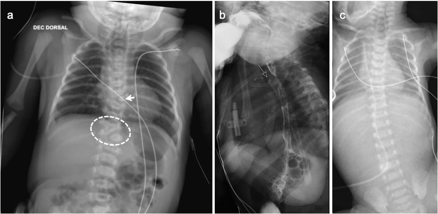 Imaging of neonatal bowel obstruction | Radiología (English Edition)
