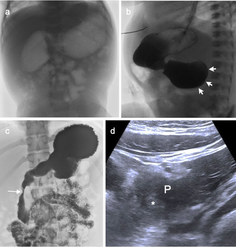 Imaging of neonatal bowel obstruction | Radiología (English Edition)