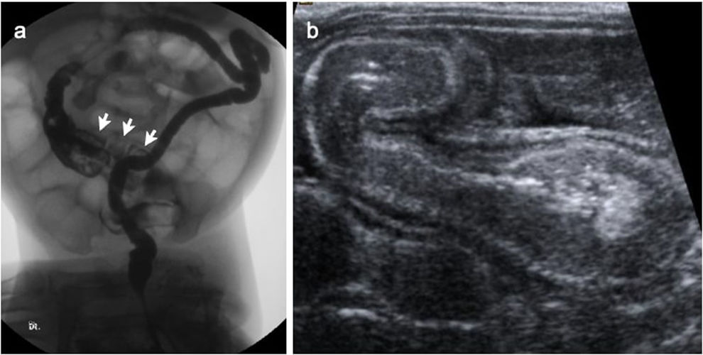 Imaging of neonatal bowel obstruction | Radiología (English Edition)