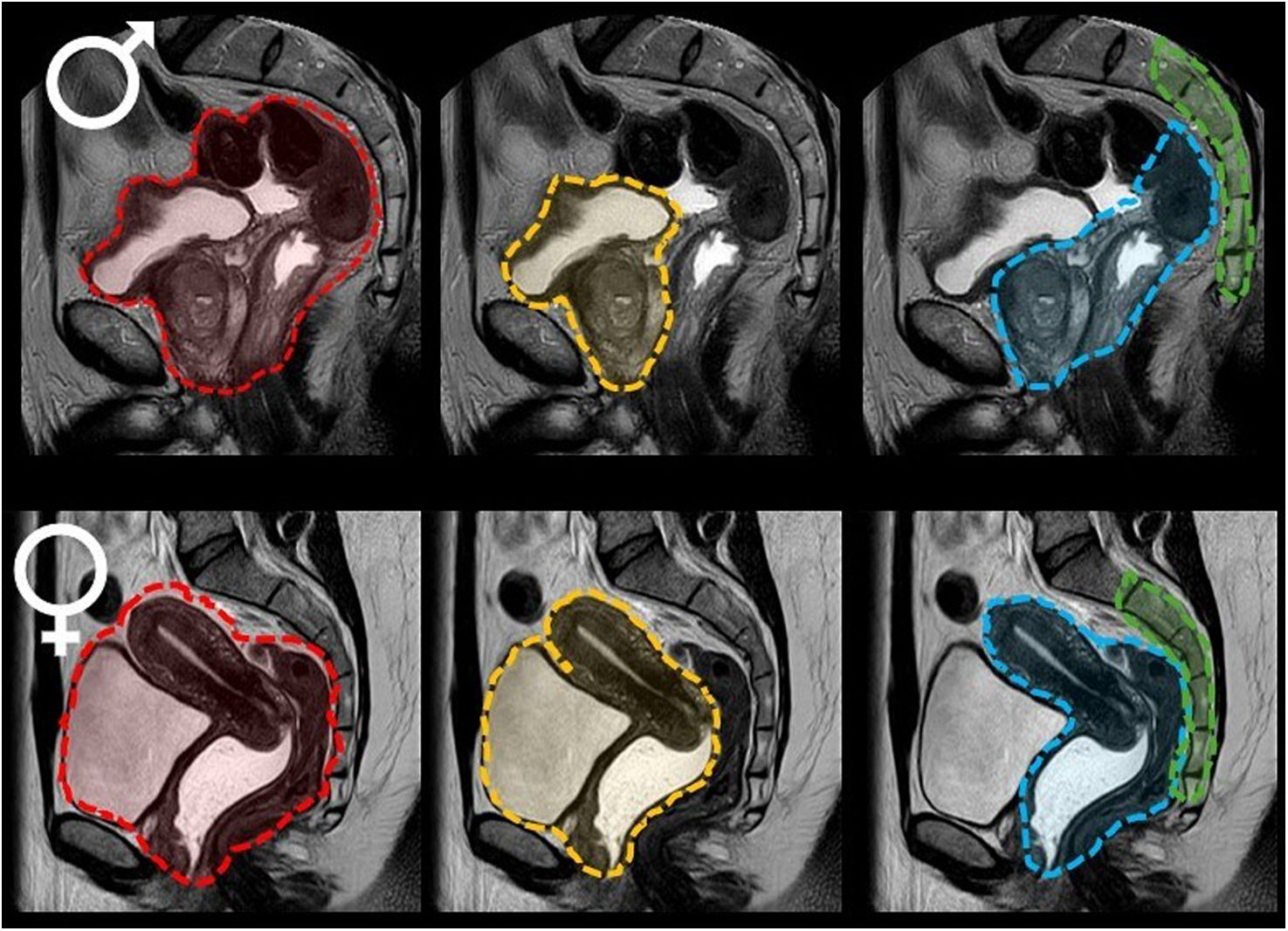Pelvic exenteration: The radiologist’s role | Radiología (English Edition)