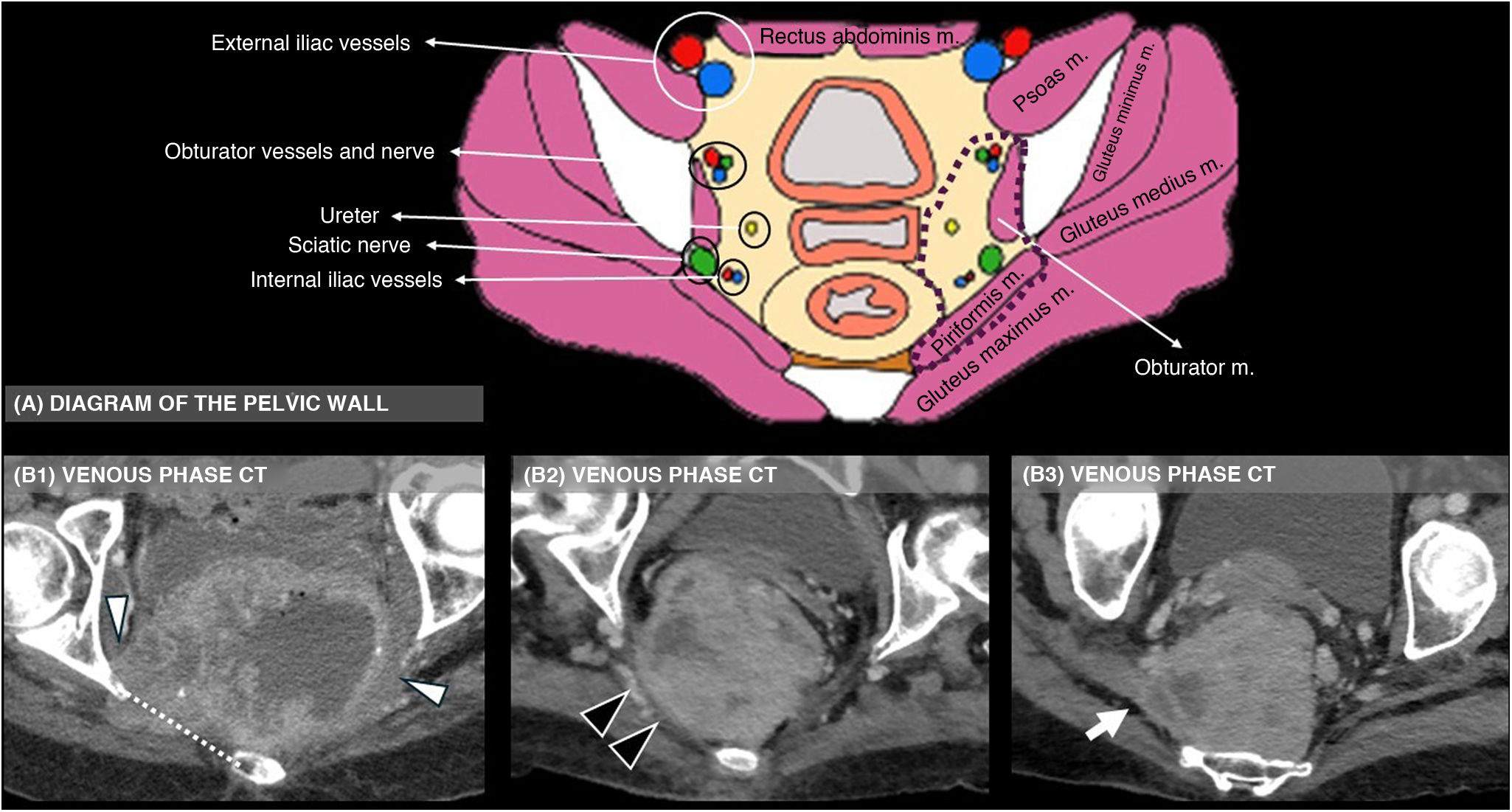 Pelvic exenteration: The radiologist’s role | Radiología (English Edition)
