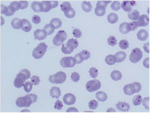 Picture of the patient's peripheral blood smear showing a very high level of parasitemia with images of trophozoites and merozoites, as well as significant schizocytes. There were no gametocytes and therefore cannot be seen here.