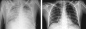 Chest anteroposterior teleradiography of the 5th day, on the left, and of the 10th day of hospitalization, on the right.