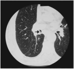 Chest CT scan shows an endobronchial mass (arrow) causing obstruction of the inferior lobar bronchus.