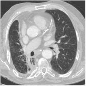 Ten-year follow-up chest CT scan shows a diffuse density in the subcarinal and right hilar regions extending to the right pulmonary artery, thought to be scarring rather than tumor re-growth.