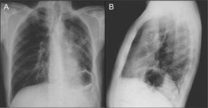 PA and left lateral chest X-ray on admission.