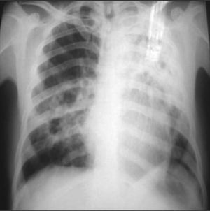 PA chest X-ray upon admission.