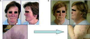 Cutaneous involvement of patient no. 1 before (A) and after (B) infliximab treatment.