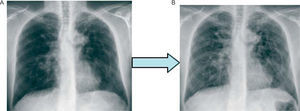 Chest X-Ray film of patient no. 4 at the time of diagnosis (A) and after evolution to fibrosis (B).