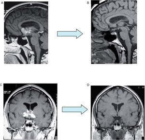 A, B, C, D: neurological involvement of patient no. 6 before (A and C) and after treatment with infliximab (B and D).