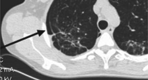 Pneumothorax and fibrotic changes in the most recent thoracic CT scan of patient no.
