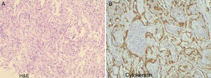 Lung histology (A – H&E, B – Cytokeratin): diffuse parenchymal lung changes; marked enlargement of the alveolar septa, foci of edema and mild to moderate lymphocytic infiltrate with rare neutrophils and some eosinophils. Frequent intra-alveolar myofibroblast proliferation with small nodules present. These are partially coated with highly reactive pneumocytes. No granulomas, vascular thrombi or neoplastic proliferation are identified. These aspects are indicative of a process of organizational and exsudative interstitial pneumonia.