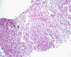 Histopathologic slide (hematoxylin and eosin, 200x) - septal thickening with lymphocytic infiltration involving polymorphonuclear eosinophils. Proteinaceous exudate and, focally, fibrosis and inflammatory cells in a myxoid stroma in intra-alveolar location.