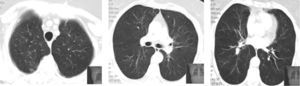 Chest computed tomography - resolution of lung infiltrates.