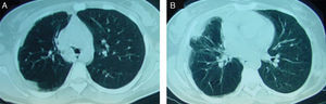 Chest computed tomography scan. Well defined occlusive opacity in the right main bronchus (A) Middle lobe consolidation with air bronchogram and a homolateral loculated pleural effusion (B).