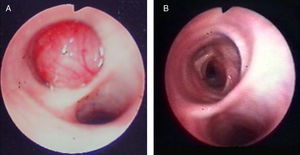Flexible bronchoscopy. Right main bronchus before (A) and after endobronchial leiomyoma laser resection (B).