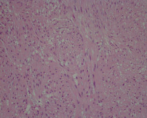 Histopathologic slide (Hematoxylin and eosin stain, 20x). Fusocellular proliferation of spindle cells with cigar-shaped nuclei and eosinophilic cytoplasms, with no atypias or areas of necrosis and no mitotic activity.