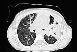 Computerized axial tomography to reveal upper and left lower lobe pneumonia.