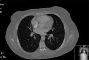 Thoracic CT – nodular tumor in medium lobar bronchus.