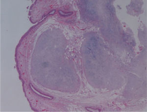 Well-limited, lobulated, sub-mucous neoplasm, with mixoid pattern.