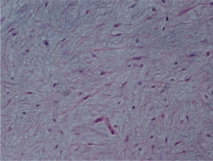Detail of Fig. 6, showing stellate with no atypia, mixoid stroma, without cartilaginous differentiation.