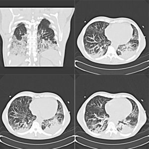 A 39-year-old man with Influenza A (H1N1) virus pneumonia and severe respiratory failure (PaO2/FIO2 at admission 170) respiratory underwent non-invasive mechanical ventilation: chest computed tomography shows alveolar consolidation, peripheral ground-glass opacities in both middle and lower lung zones and small bilateral pleural effusions.