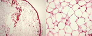 Hematoxylin–eosin staining of the specimen revealed a well-circumscribed lipoma with an intact fibrotic capsule containing mature adipocytes (A, 20×). The mature adipocytes varied slightly in size and shape and had small eccentric nuclei (B, 200×).