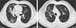 Pulmonary HRCT findings. Left: Middle lobe consolidation with air broncogram and architectural distortion. Scattered ‘ground glass’ pattern through the left lung. Bilateral granulomas, some with cavitation (arrows). Mediastinal pleura spiculated thickening. Right: Right upper lobe paracicatricial enphysema and cavitation. Left lung parenchymal band (arrow) and interlobular septal thickening.
