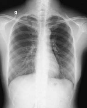Follow-up chest radiograph showed complete resolution of subcutaneous emphysema and pneumothorax.