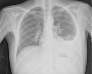 Patient chest X-rays at hospital admission showed the presence of left pleural effusion.