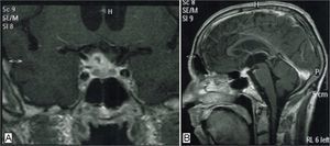 Cerebral magnetic resonance imaging showed intrasellar lesion very suggestive of a tuberculous granulomas (A – coronal view, B – sagittal view).
