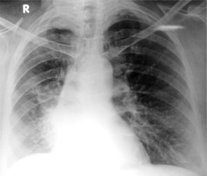 Chest radiograph showing elevation of the right hemidiaphragm with silhouetting of the right cardiac border.