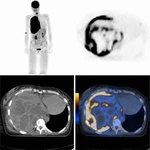 PET/CT: Extensive right pleural hypermetabolic involvement with high probability of malignancy, a mass in the postero-inferior area which invaded the adjacent thoracic wall, suspicious homolateral pleural effusion and secondary mediastinal and bronchohilar lymph node involvement.