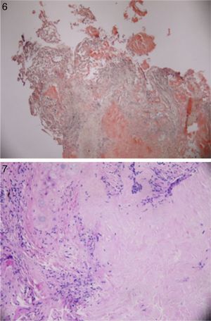 Histology showing congo red staining confirming diagnosis of amyloid. For interpretation of the references to color in this figure legend, the reader is referred to the web version of the article.)