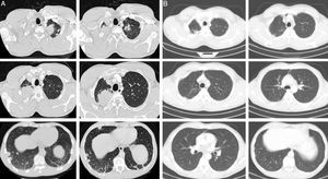 Chest CT at the time of diagnosis (A) and 3 months after chemotherapy (B). (A) Multiple nodular lesions in both lungs. The bigger lesions present in the apices. (B) Resolution of the nodular lesions after 3 cycles of chemotherapy. Some fibrotic sequelar changes can be seen in both apical regions.