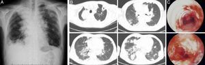 (A) and (B) Chest radiograph (A) and CT (B) at the time of symptom relapse (15 months after chemotherapy), show multiple irregularly shaped nodules and masses, some of which exhibiting cavitation. (C) Bronchoscopic features evidencing multiple ulcerating lesions and superficial vascularization, along the whole tracheobronchial tree.