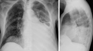 Chest radiograph at first observation.