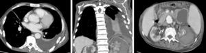 CT – left free pleural effusion and retroperitoneal fluid collection.