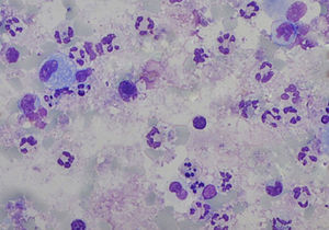 Induced sputum smear showing numerous polymorphonuclear neutrophils (May–Grünwald Giemsa stain, original magnification 400×).