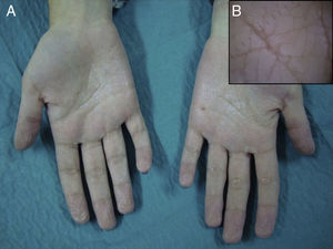 (A) Palmar skin after 5min water immersion: subtle whitish, edematous and flat-topped papules became apparent. (B) Detail on dermoscopy.