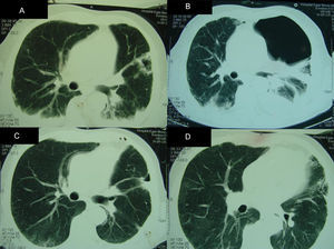 Radiologic findings during hospital admission. Computed tomographies (CT) of the thorax demonstrating: (A) (4th week after admission) bilateral pleural effusion and condensation, with an aspergilloma on left hemithorax; (B) (9th week after admission) hydropneumothorax; (C and D) (6th month after admission) improvement of pleural effusion and hydropneumothorax. Aspergilloma was removed during the surgery.