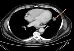 Thoracoabdominal Tomography revealing a left paracardiac nodular image with 4cm×2cm diameter, with irregular limits, aspects in probable relation with a neoplastic lesion.