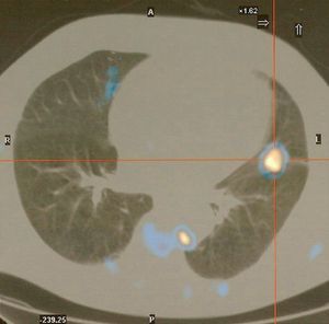 Whole body positron emission tomography showing foci with abnormal fluorodeoxyglucose uptake, increased significantly in the lingual and pre-veterbral lymph nodes.