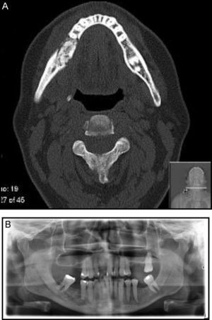 (A) Face CT: marked change in the bone trabeculation of the body of the jaw to the right, about 3.5cm long and (B) orthopantomography showing changes on right jaw.