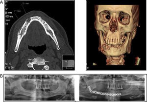 (A) Face CT 3D: alteration in bone trabeculation of the body of the right jaw, with 4.2cm×1.1cm in length and (B) orthopantomography before and after maxillo-facial surgery: resection of the body of the right jaw was performed and fibula bone flap was fixed with reconstructive plaque.