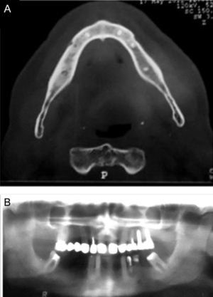 (A) Face CT 3D: irregularity of the cortical bone in the right jaw and (B) orthopantomography confirming the changes in the face CT.