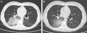 Chest high-resolution computed tomography (HRCT) at diagnosis (A) and two years after diagnosis (B). Bilateral lung infiltration in the lower lobes, particularly on the right side in the area of segment S6, with the following dimensions: 85mm×38mm×70mm. The surrounding tissue shows ground-glass opacities, thickened interlobular septa, and a craving paving picture with air bronchogram (A). Partial regression of pulmonary infiltration after discontinuation of “baby body oil therapy” (B).